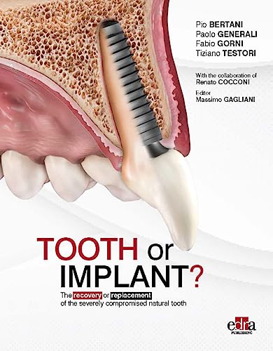 Tooth Or Implant? The Recovery Or Replacement Of The Severely Compormised Natural Tooth