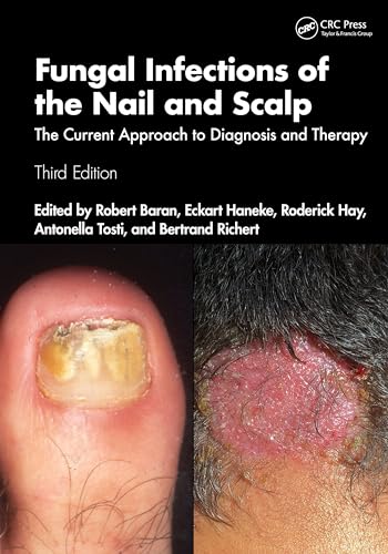 Fungal Infections Of The Nail And Scalp: The Current Approach To Diagnosis And Therapy