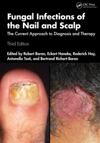 Fungal Infections of the Nail and Scalp: The Current Approach to Diagnosis and