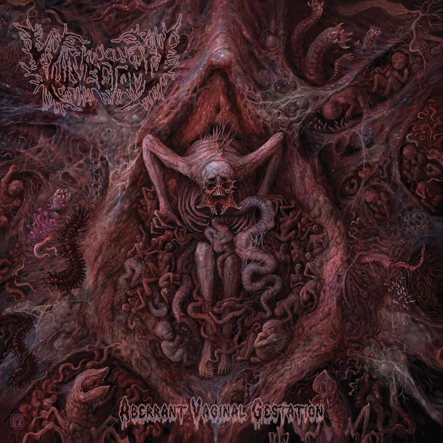 Vulvectomy Gestazione vaginale aberrante (CD)