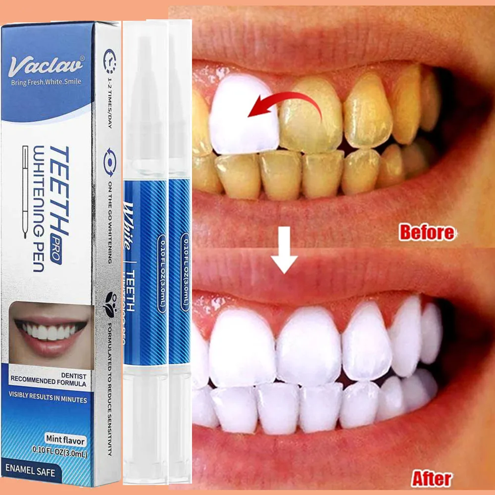 Odontoiatria Penna Sbiancante Per Denti Gel Per Denti Prodotti Dentali Sbiancante Per Gel Per Denti Candeggina Rimuovi Macchie Kit Sorriso Istantaneo 