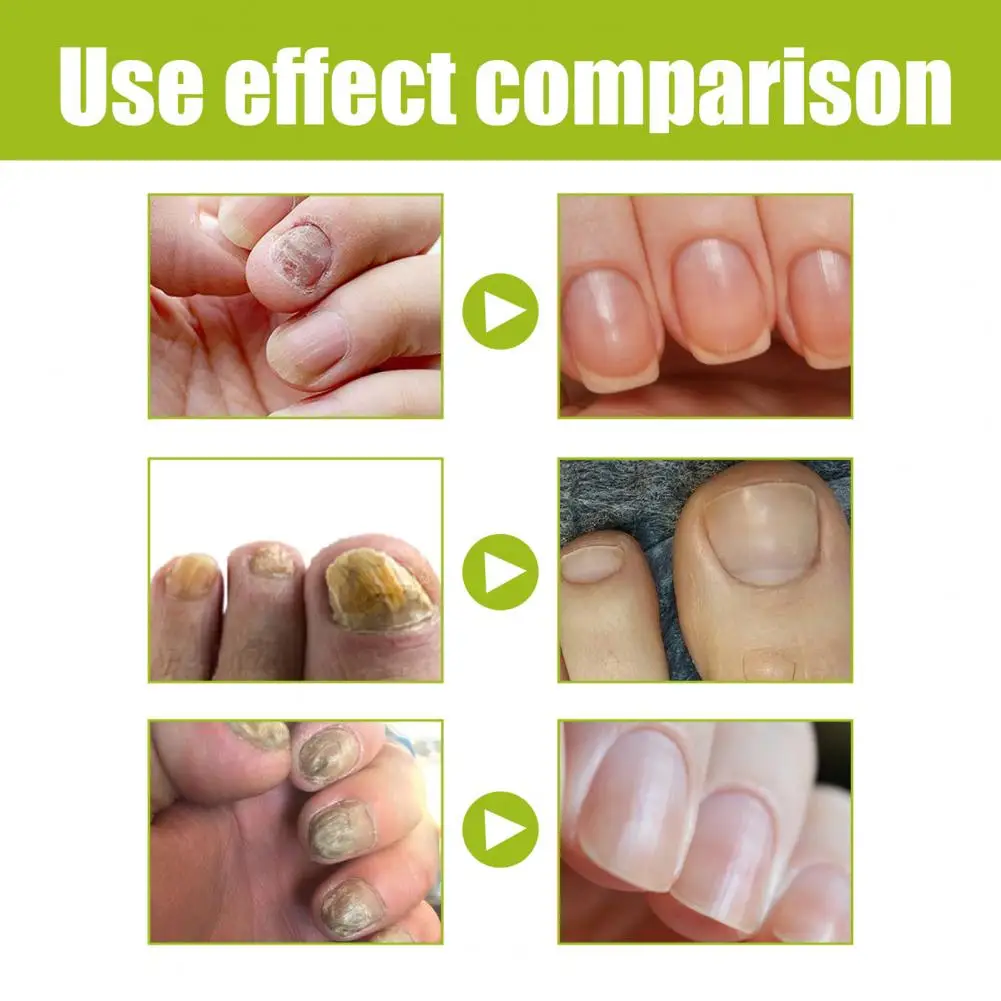 Pratico Gel Per La Riparazione Delle Unghie In Gel Per La Riparazione Delle Unghie Morbido Per Aumentare La Lucentezza Della Cura Delle Unghie