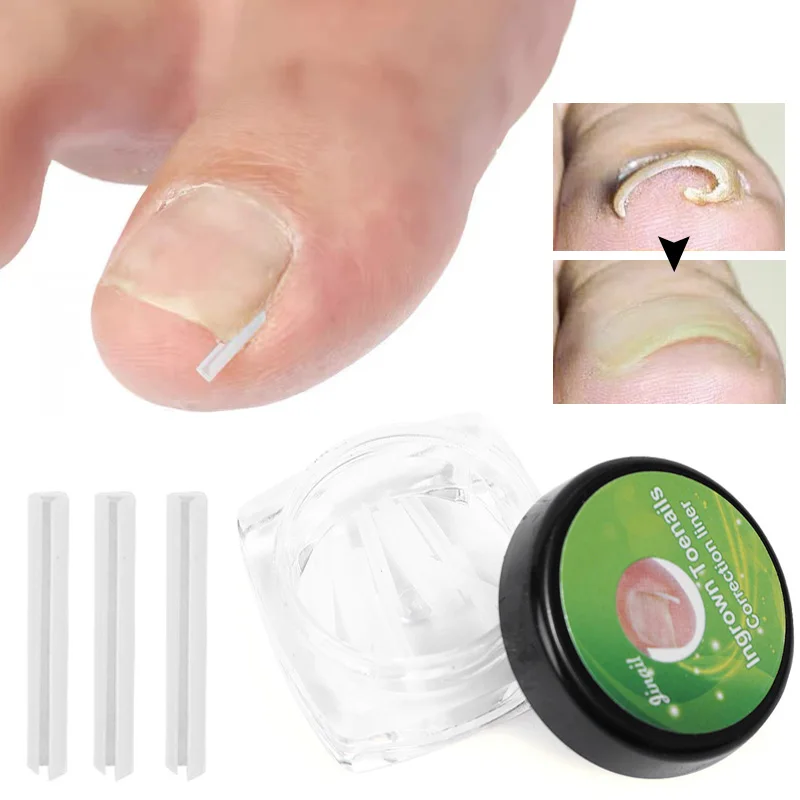 10Pcs/Box Nail Filling Nail Groove Pad Ingrown Toe Nail Correction Pad Paronychia Correction Curved Pad Ingrown Correction Tool