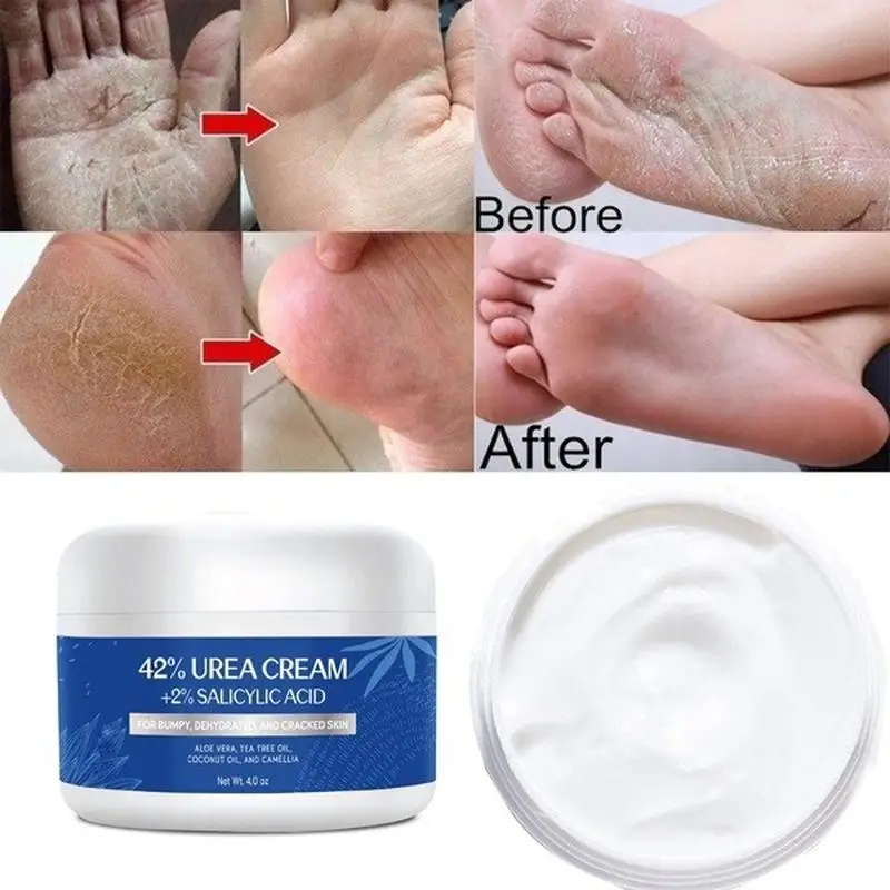 Urea Cream 42% Plus Acido Salicilico 4 Oz, Crema Per Le Mani Con Rimozione Del Callo Aggiornata Crema Per I Piedi Per Piedi Screpolati Secchi, Mani,