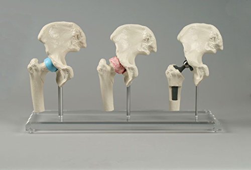 Hüft-Implantat-Modell