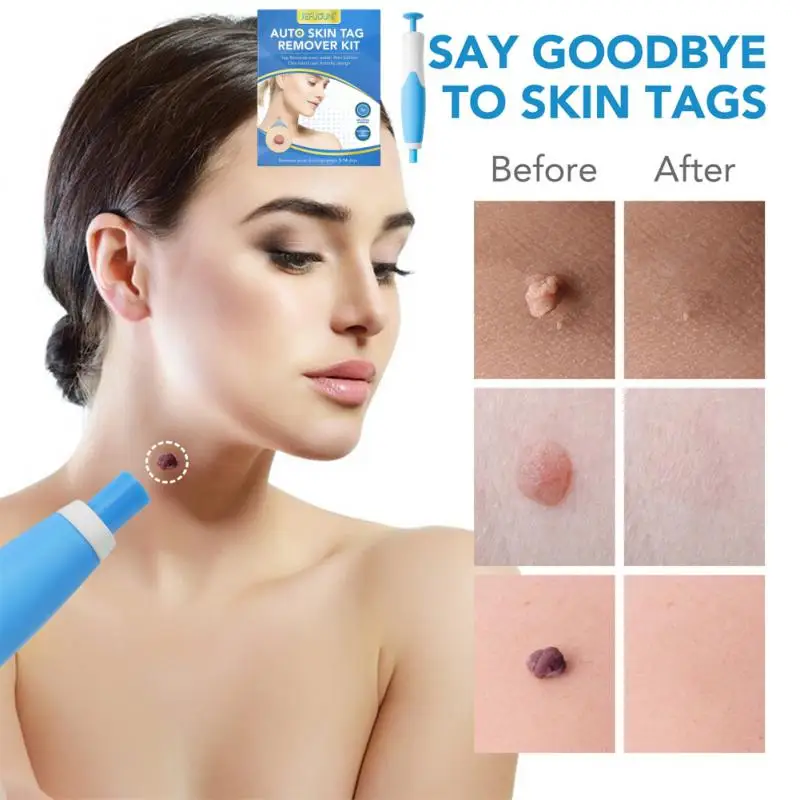 2 In1 Indolore Auto Skin Tag Mole Removal Kit Strumenti Per La Pulizia Cura Della Pelle Del Viso Trattamenti Per Punti Del Corpo Rimozione Bellezza Sa