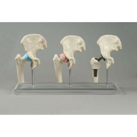 Erler Zimmer, modello anatomico di articolazione dell'anca, con protesi 1115