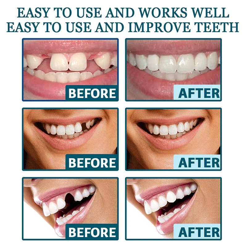 Sdutter Nuovo Set Di Denti Per Protesi Regolabili Dentiera Sorridente Istantanea Impiallacciatura Di Denti Sbiancamento Denti Protesi Bretelle Denti R