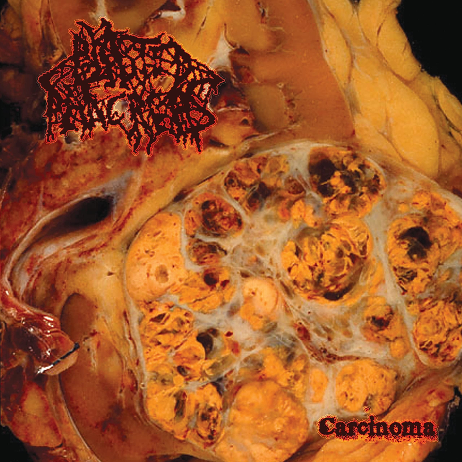 Blasted Pancreas Carcinoma (Vinyl LP)
