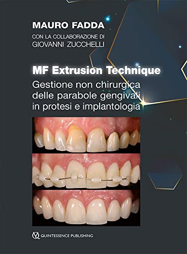 Gestione Non Chirurgica Delle Parabole Gengivali In Protesi E Implantologia. Mf Extrusion Technique