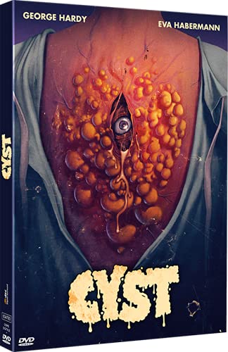 Cyst