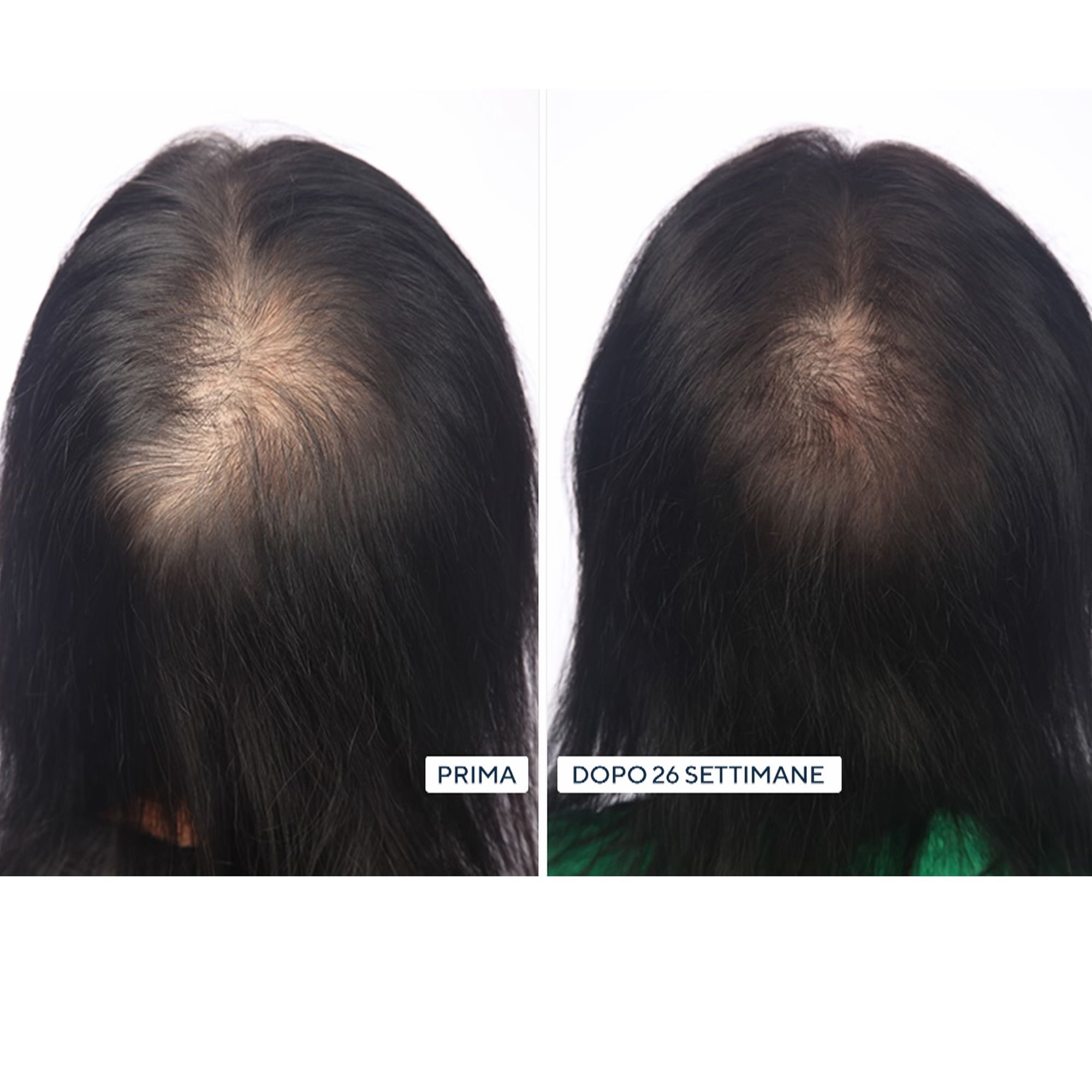 HairMax LaserBand Dispositivo laser crescita capellI
